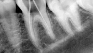 rootcanal3