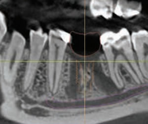 Link to more info about Computer Guided Dental Implants