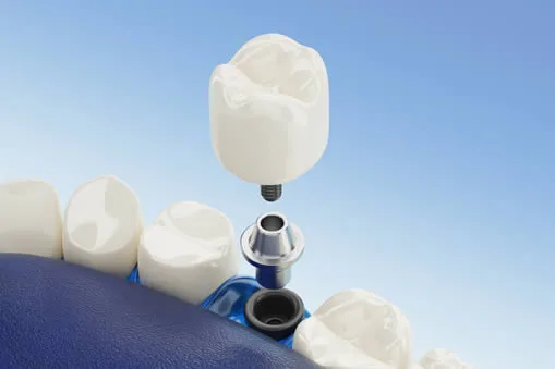 Computer Guided Dental Implants