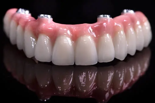 implant supported denture top