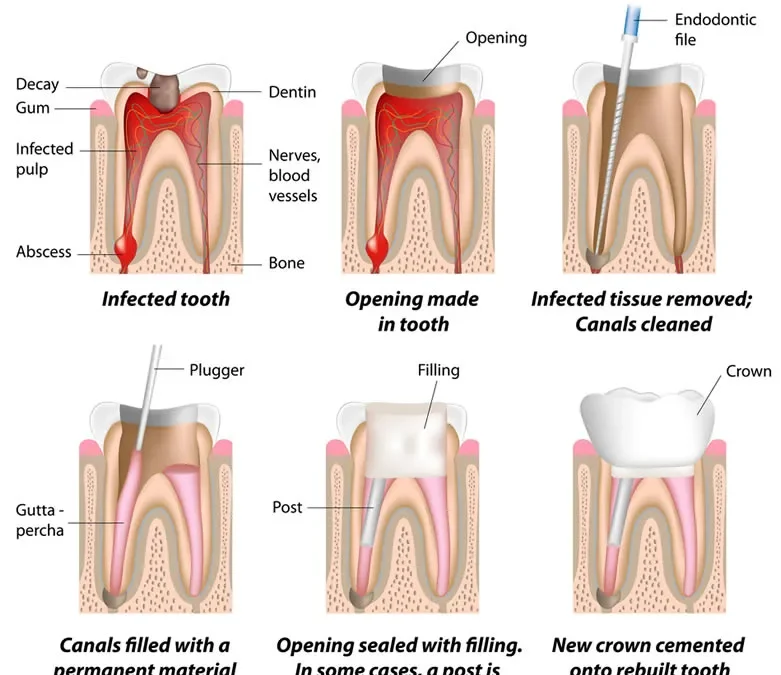 Root Canal Therapy